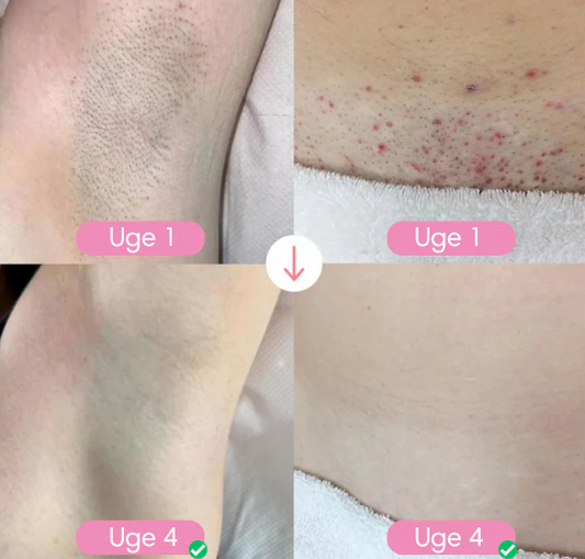 LaserSkøn™ | Laserhårfjerning | I dag 50% rabat